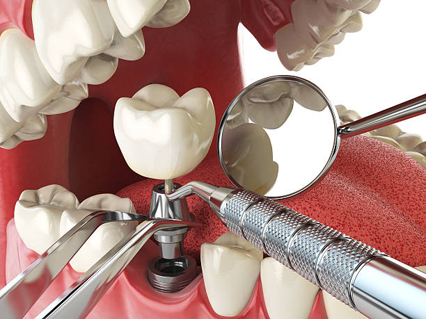 Best Emergency Dental Care for Sports Injuries in West Hattiesburg, MS